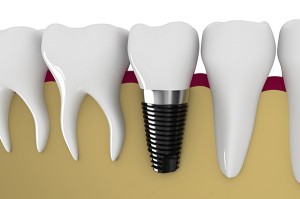Dental-Implants112-2015