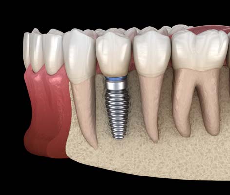 When Bone Grafting Is Needed For Dental Implants