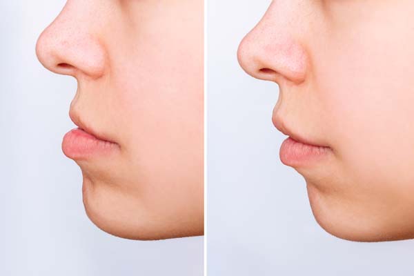 What Is Corrective Jaw (Orthognathic) Surgery?