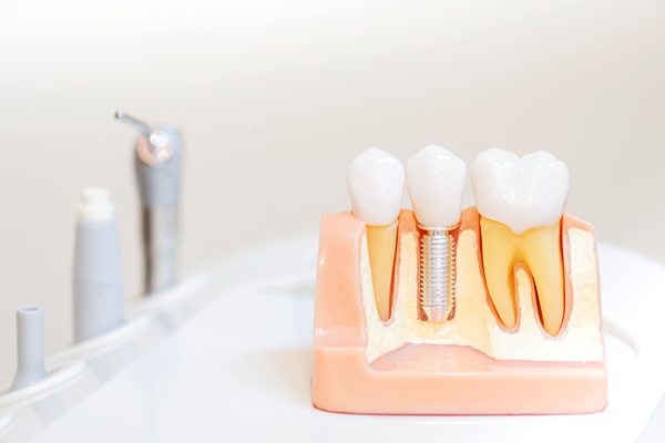 Proper Care For Dental Implants