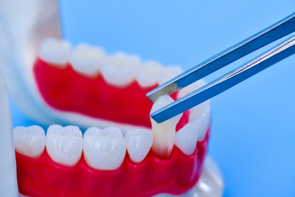 The Role Of Dental Implants In Your Oral Health And Function