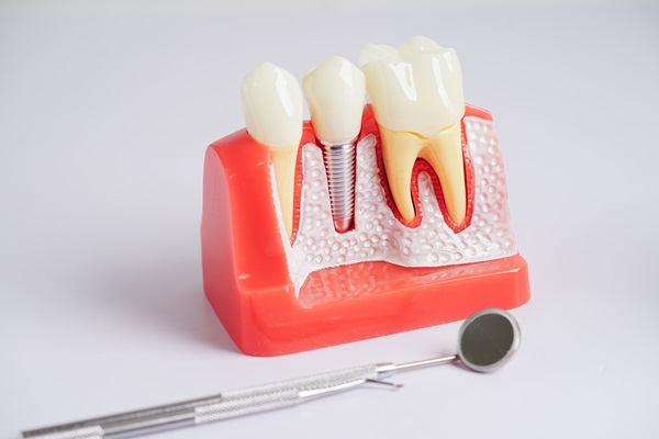 Benefits To Replace Missing Teeth With Dental Implants