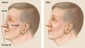 l_rhinoplasty