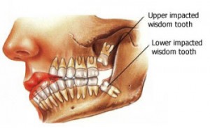 l_wisdomteeth