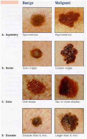 skin cancer